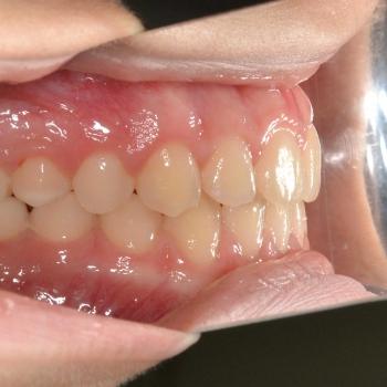 Kezelés után - bal oldalról