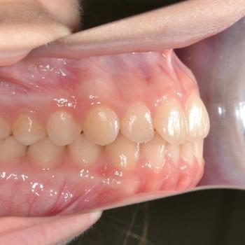 Kezelés előtt - bal oldalról