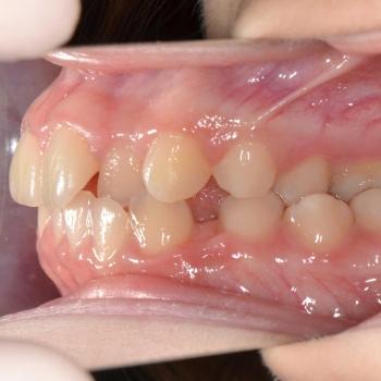 Kezelés előtt - jobb oldalról