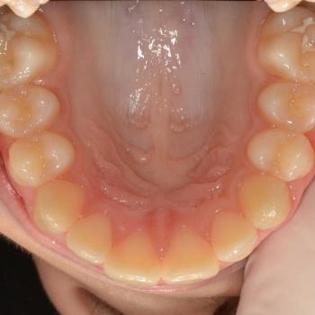 Kezelés után - felső rágófelszín