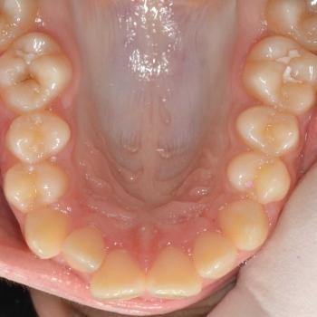 Kezelés előtt - felső rágófelszín