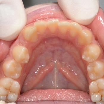 Kezelés előtt - alsó rágófelszín