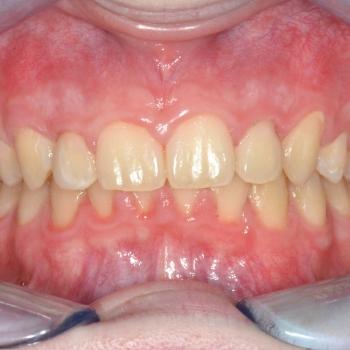 Kezelés után - szemből