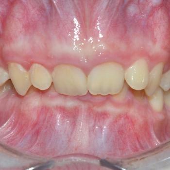 Kezelés előtt - szemből