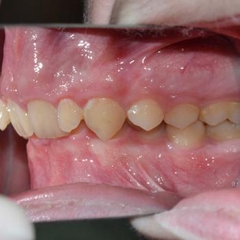 Kezelés előtt - jobb oldalról