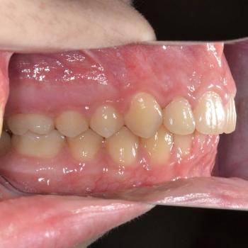 Kezelés után - bal oldalról