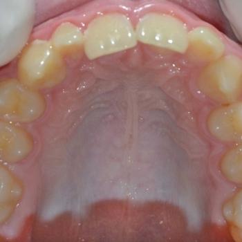 Kezelés előtt - felső rágófelszín