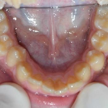 Kezelés előtt - alsó rágófelszín