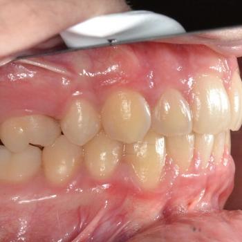 Kezelés után - bal oldalról