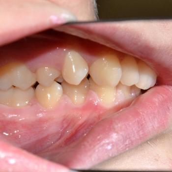 Kezelés előtt - bal oldalról