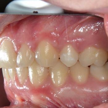 Kezelés után - jobb oldalról