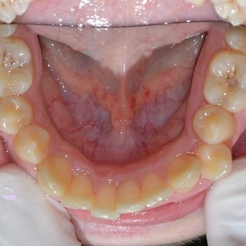 Kezelés előtt - alsó rágófelszín