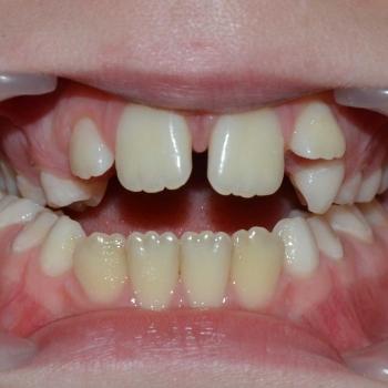 Kezelés előtt - szemből