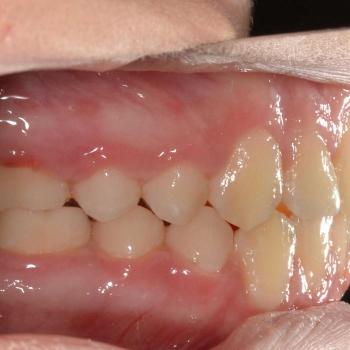 Kezelés után - bal oldalról