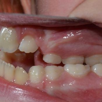 Kezelés előtt - jobb oldalról