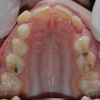 Kezelés előtt - felső rágófelszín