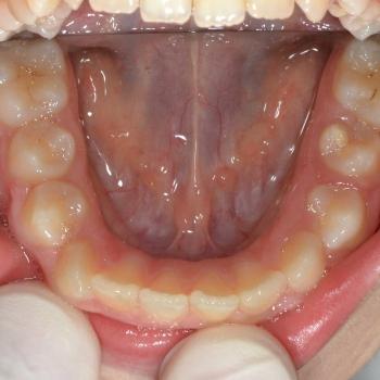 Kezelés előtt - alsó rágófelszín