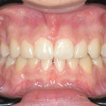 Kezelés után - szemből