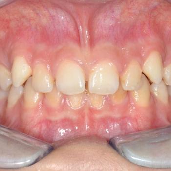 Kezelés előtt - szemből