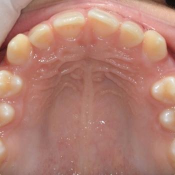 Kezelés előtt - felső rágófelszín