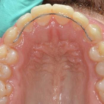 Kezelés után - felső rágófelszín