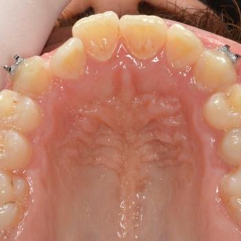 Kezelés előtt - felső rágófelszín