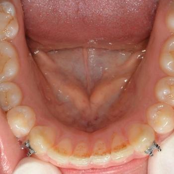 Kezelés előtt - alsó rágófelszín