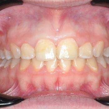 Kezelés után - szemből