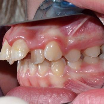 Kezelés előtt - jobb oldalról