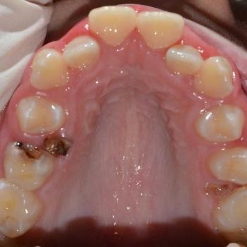 Kezelés előtt - felső rágófelszín