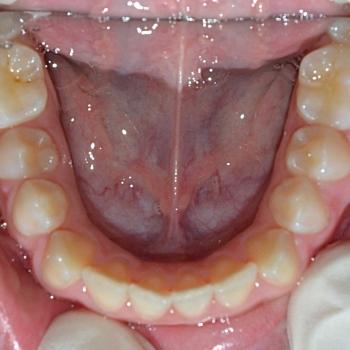 Kezelés előtt - alsó rágófelszín