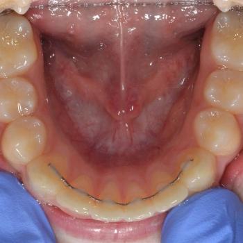Kezelés után - alsó rágófelszín