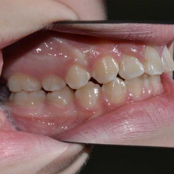 Kezelés előtt - bal oldalról