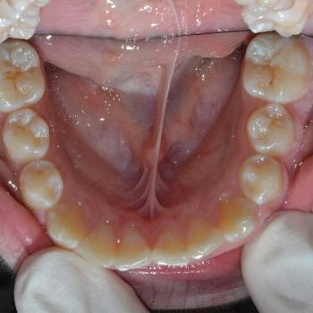 Kezelés előtt - alsó rágófelszín