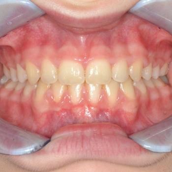 Kezelés után - szemből