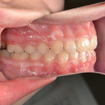 Kezelés után - bal oldalról