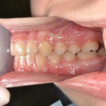 Kezelés után - jobb oldalról