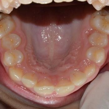 Kezelés előtt - felső rágófelszín