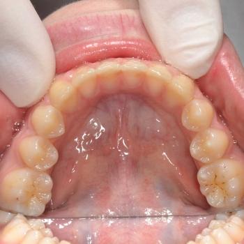 Kezelés után - alsó rágófelszín