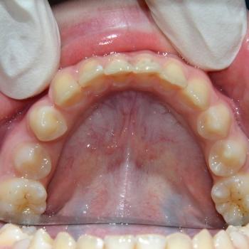 Kezelés előtt - alsó rágófelszín