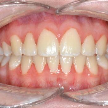 Kezelés után - szemből