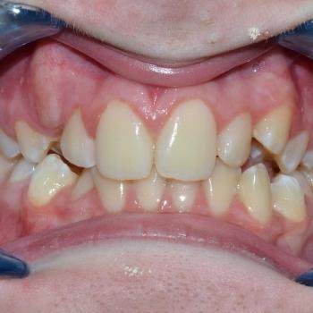 Kezelés előtt - szemből