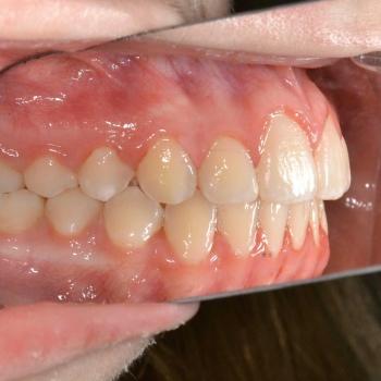 Kezelés után - bal oldalról