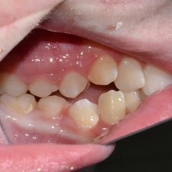 Kezelés előtt - bal oldalról