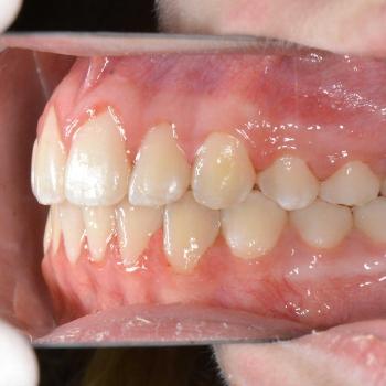 Kezelés után - jobb oldalról