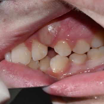 Kezelés előtt - jobb oldalról