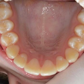 Kezelés után - felső rágófelszín