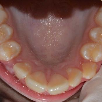 Kezelés előtt - felső rágófelszín