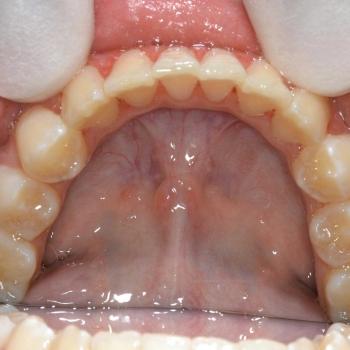 Kezelés után - alsó rágófelszín