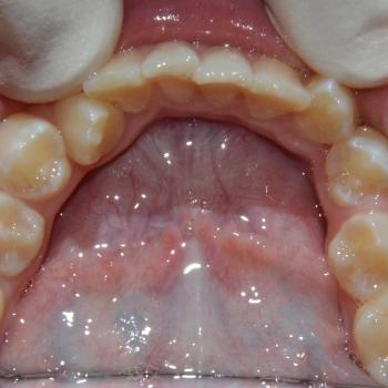 Kezelés előtt - alsó rágófelszín